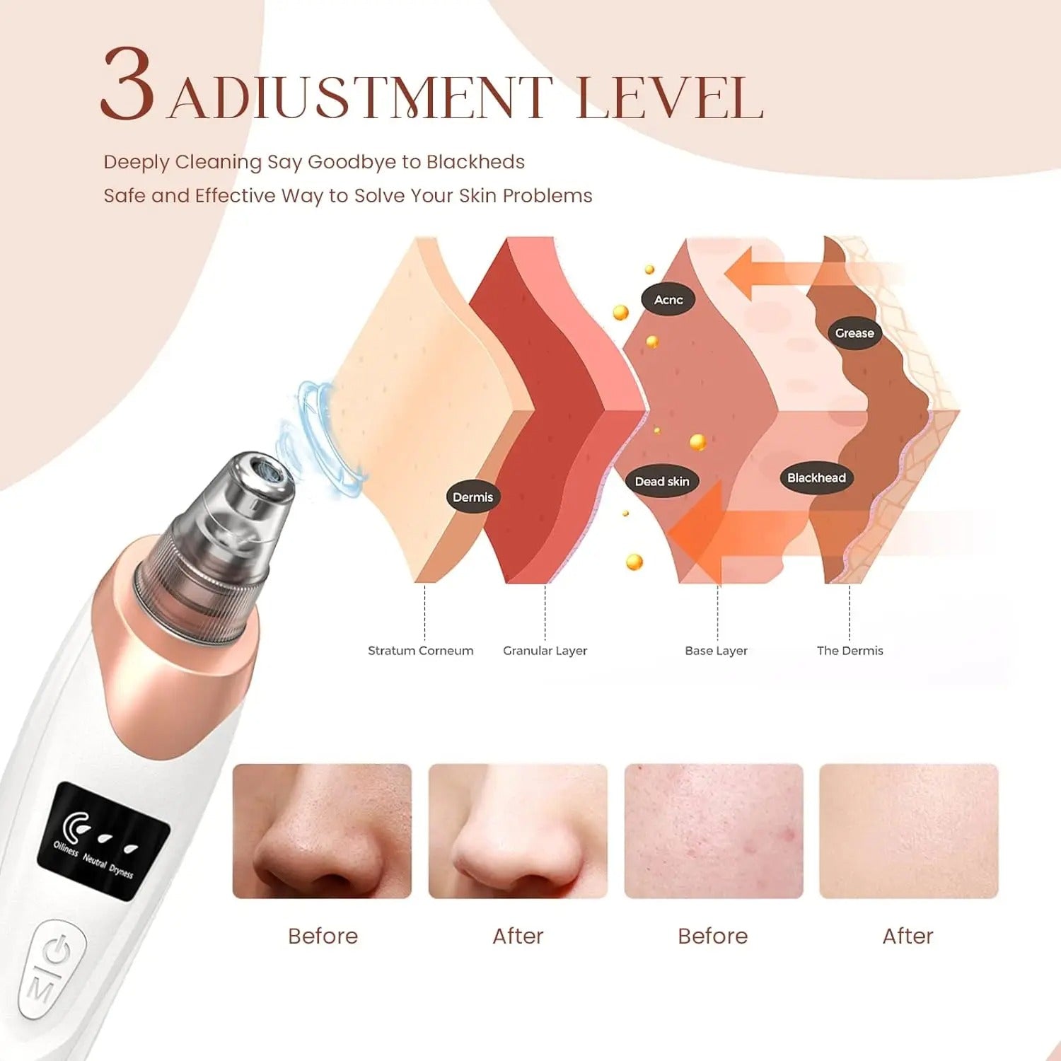 Blackhead Remover Vacuum for Deep Pore Cleaning & Acne Removal