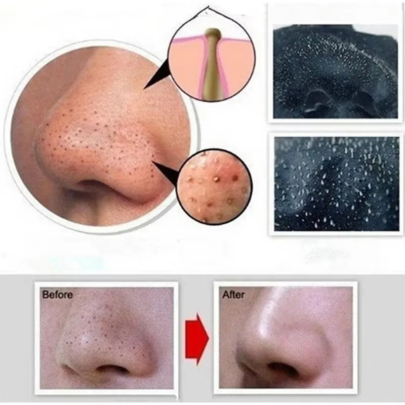 Charcoal Blackhead Mask for Deep Pore Cleansing & Acne