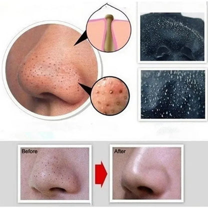 Charcoal Blackhead Mask for Deep Pore Cleansing & Acne
