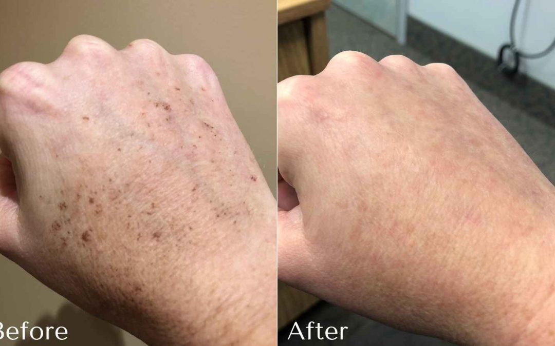 Dark Spot Corrector for Sun Spots & Age Spots | 1+1 FREE