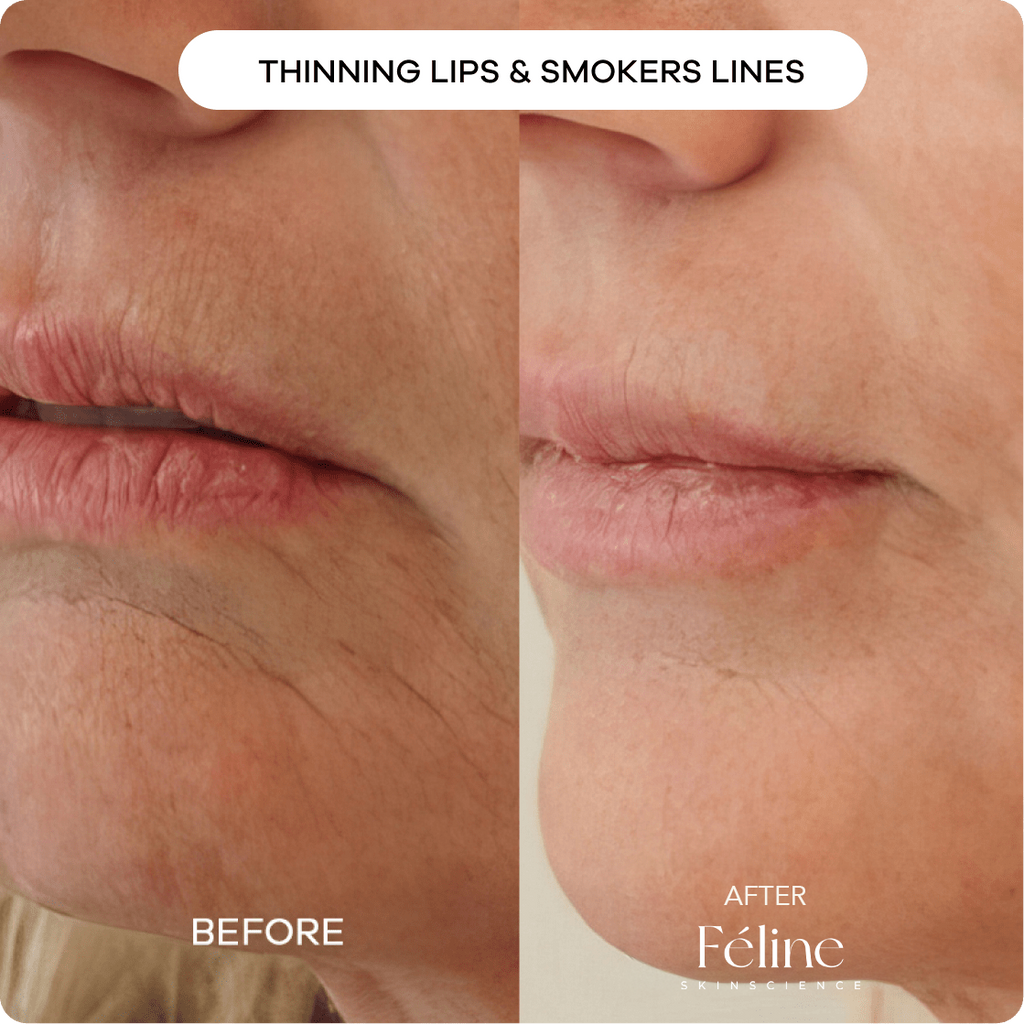 Anti-Wrinkle & Fine Line Cream | 1+1 FREE