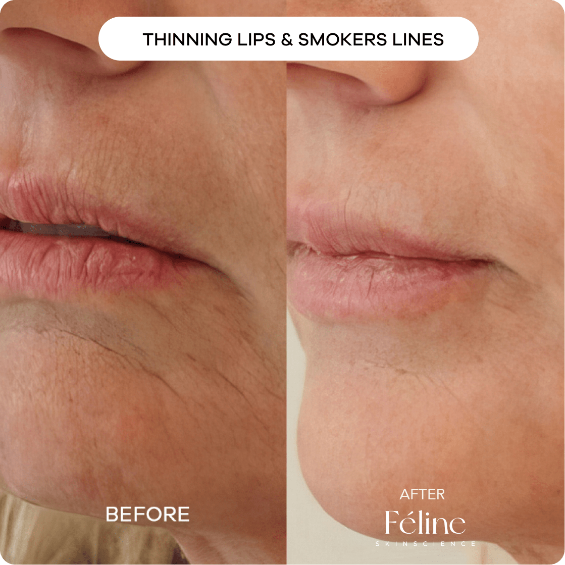 Turkey Neck Tightening Cream | 1+1 FREE