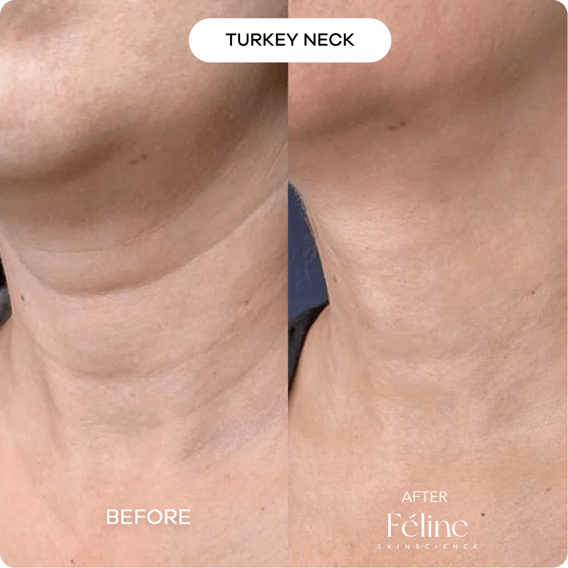 Loose Belly Skin Tightening Cream | 1+1 FREE